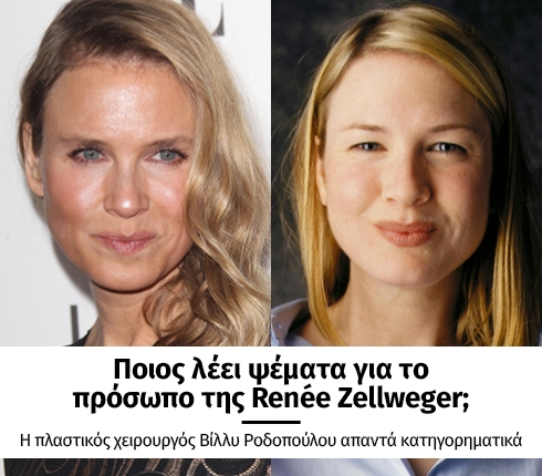 Ποιός λέει αλήθεια για το πρόσωπο της Renee Zellweger Ποιός λέει αλήθεια για το πρόσωπο της Renee Zellweger